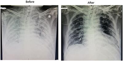 Extracorporeal Membrane Oxygenation for COVID-19: Case Report of Nine Patients